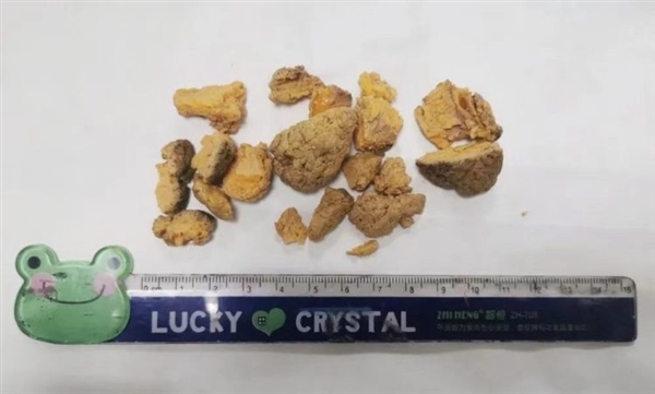 3岁女孩连吃8个柿子：胃里变化害怕！医生科普怎么食