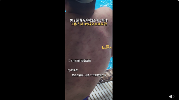 男子满背疙瘩进泳池 狂掉皮屑可怕：还敢去公共泳池吗？
