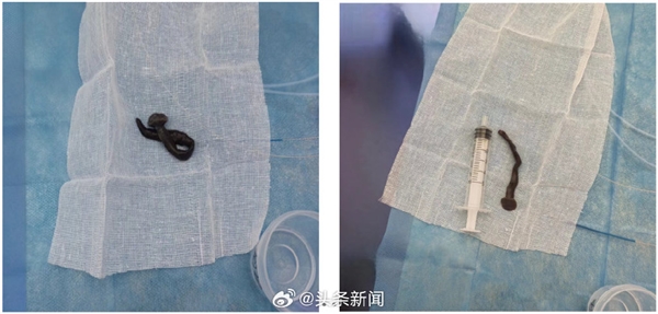 女子咳嗽半月 气管发现8cm吸血长虫:画面让网友看怕
