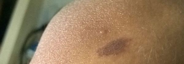 皮肤碰到硫酸怎么处理