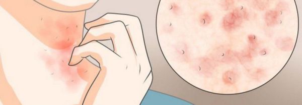 皮肤碰到衣服就特别刺痛