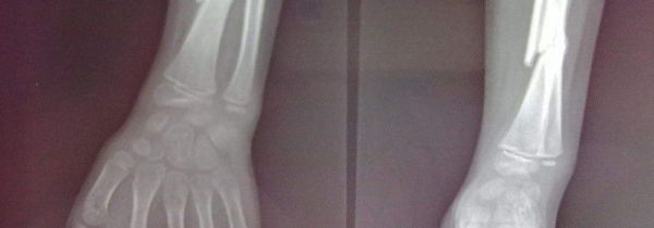 尺骨和桡骨的正确位置