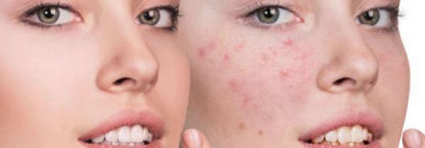 如何清洁毛孔的脏东西