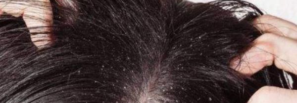 头皮除螨的方法