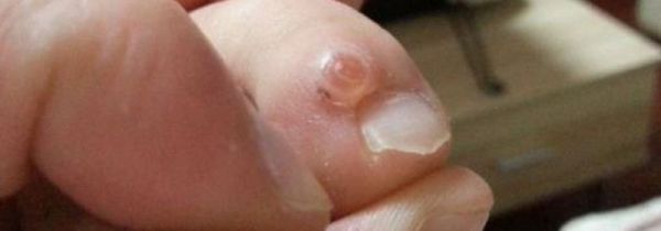 脚磨出水泡小妙招方法