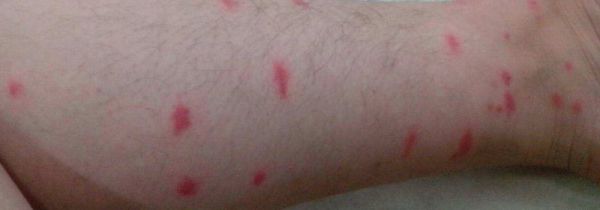 洁厕灵对皮肤的伤害